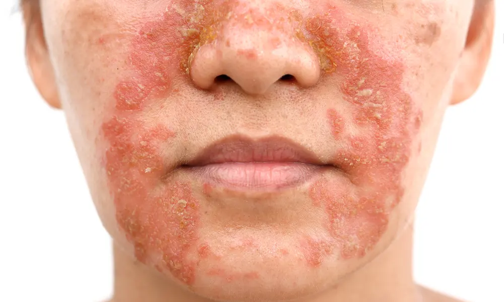 Clowneczeem wordt veroorzaakt door ontstoken talgkliertjes.