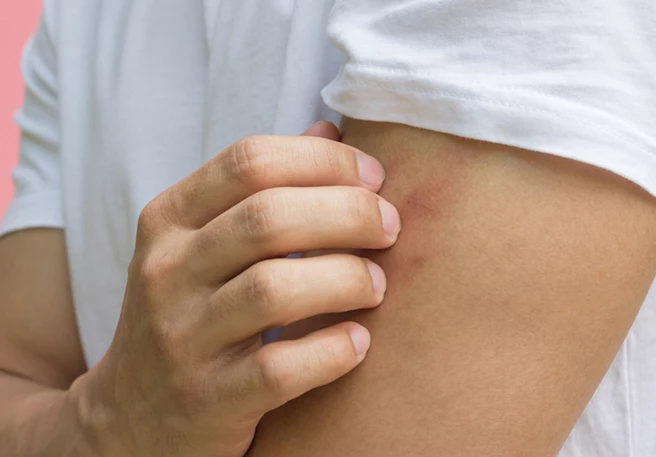 Découvrez quels sont les symptômes de l'eczéma.