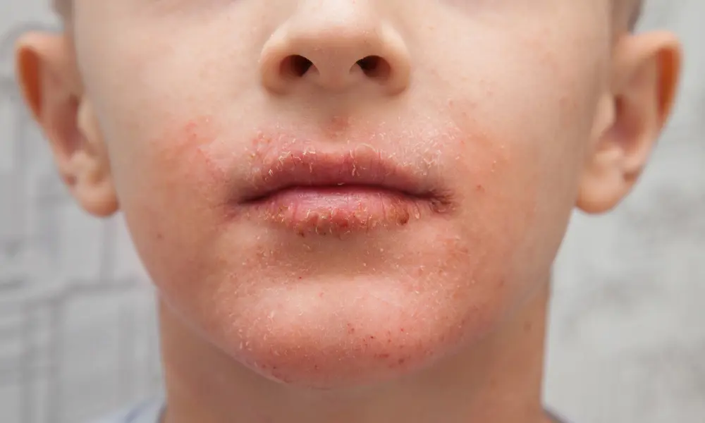 Eczeem in de mondhoeken.