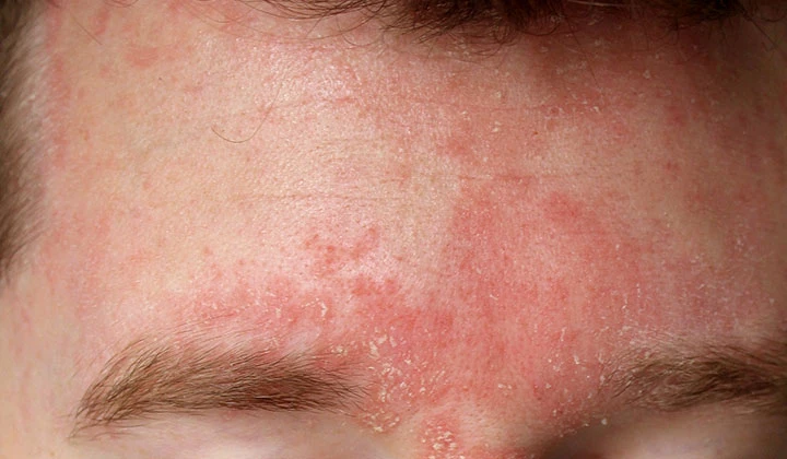 Seborroïsch eczeem valt onder de huidziekten en is een specifieke vorm van eczeem of dermatitis.