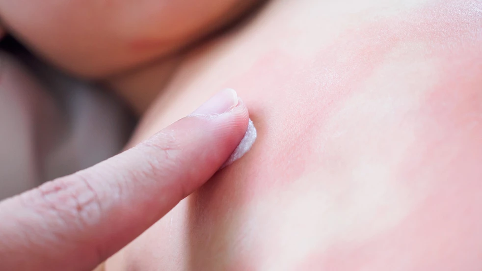 Kom er hier achter hoe je eczeem kan behandelen.