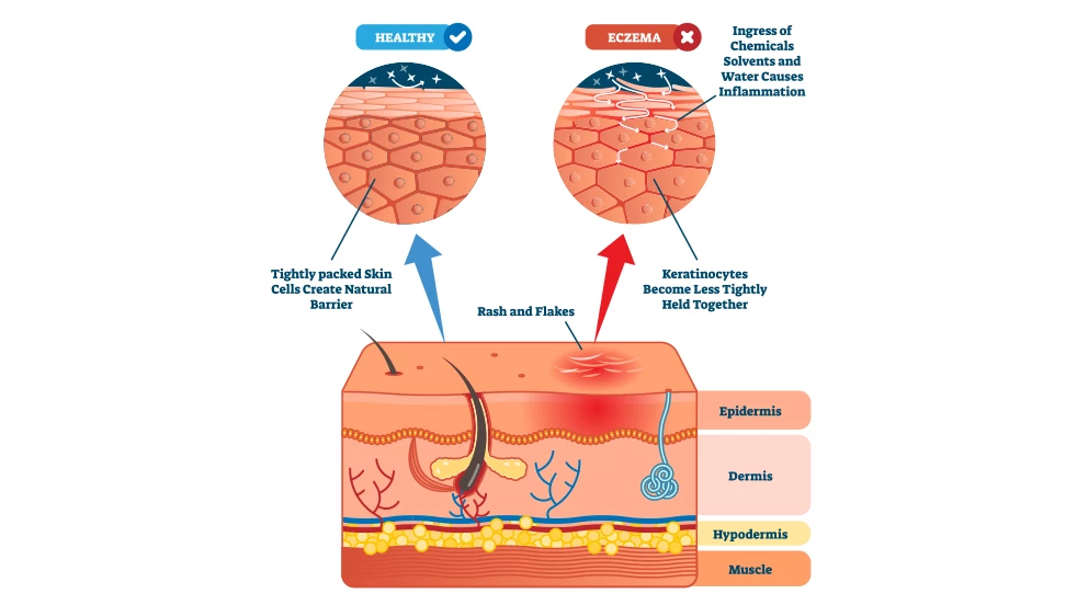 Lees hier wat eczeem is en wat de oorzaken ervan kunnen zijn.