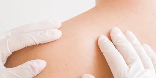 En indien er twijfel is, dan kan je dokter verder onderzoek doen via bloed, urine of ook een huidbiopsie.