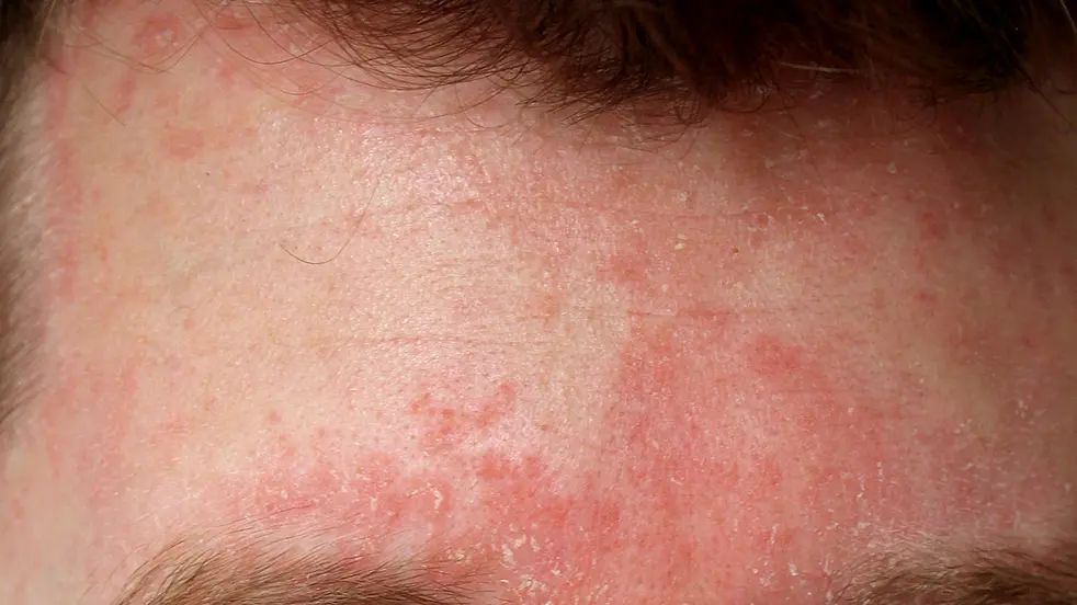 L'eczéma séborrhéique est causé par la prolifération de la moisissure Malassezia furfur.