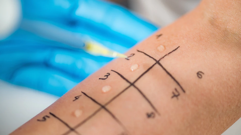 Le contact de la peau avec une substance à laquelle vous êtes allergique peut également provoquer de l'eczéma.