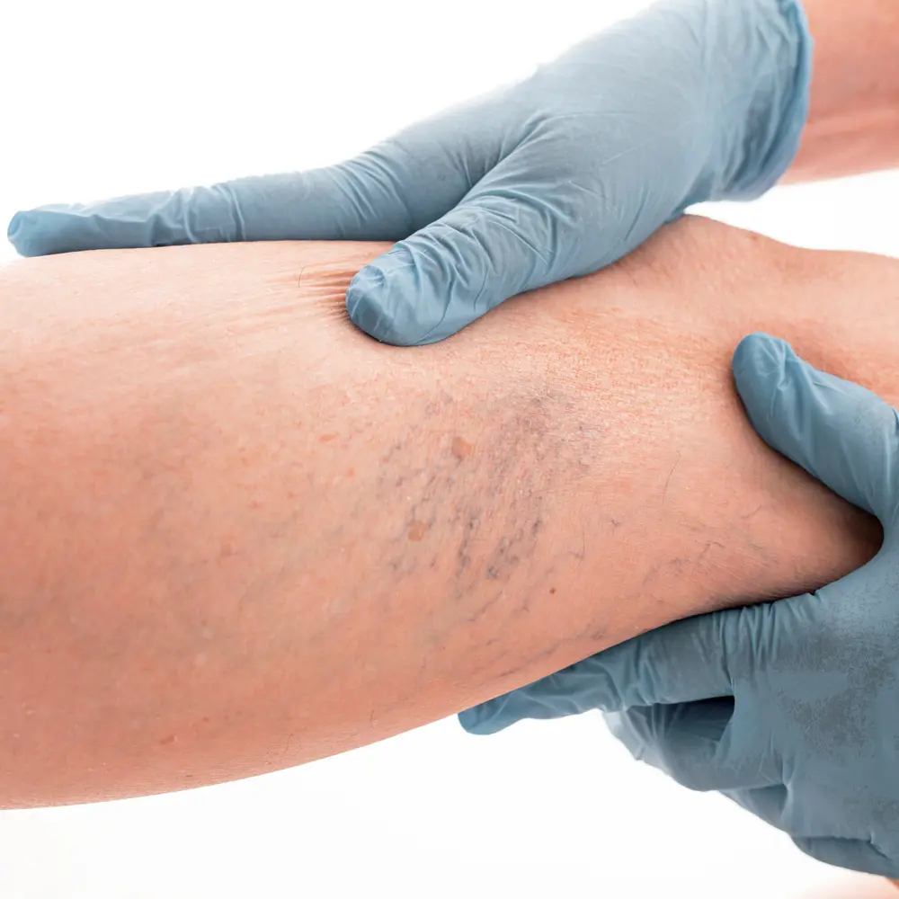 Un mode de vie sain, une compression médicale avec des bas de soutien et des médicaments aident à traiter les plaintes d'insuffisance veineuse chronique