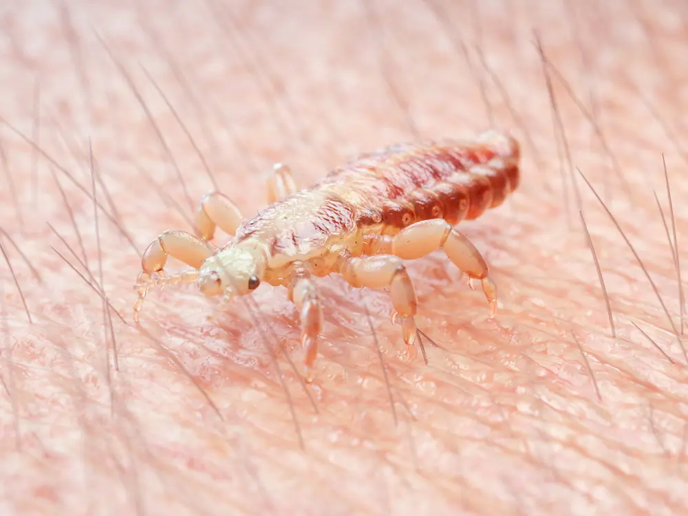 Vous avez trouvé des poux ?