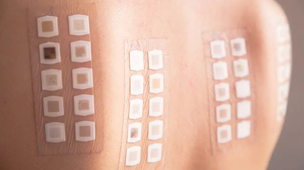 Via plakproeven op de huid kan een arts achterhalen voor welke stof je allergisch bent.