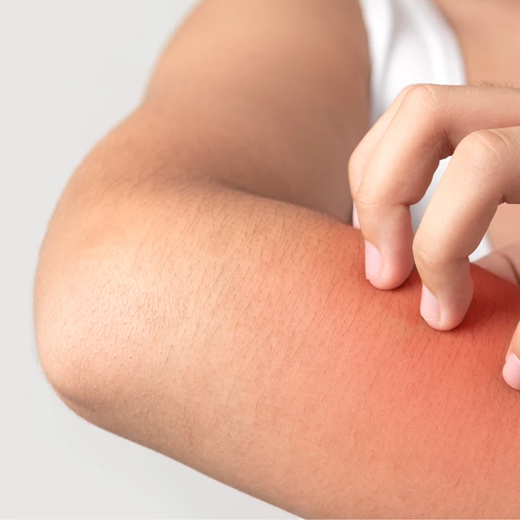 Tout sur une raction allergique de la peau | Cremicort