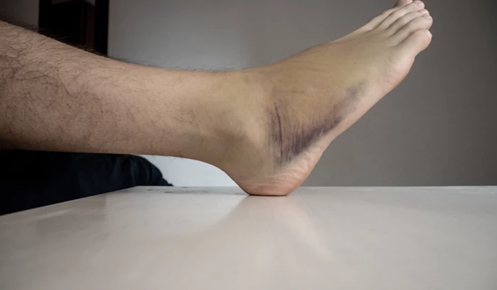 Qu’est-ce qu’une contusion ?