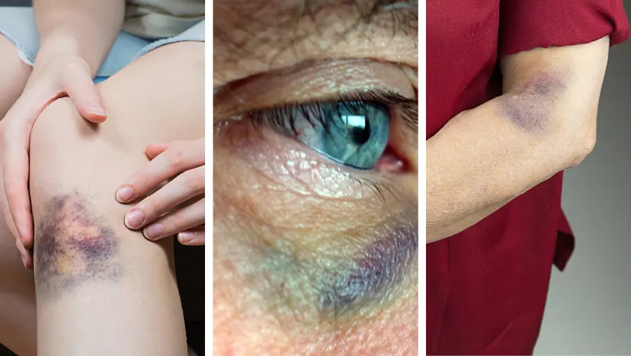 De meeste kneuzingen, zwellingen en bloeduitstortingen verdwijnen vanzelf na enkele dagen, maar met een topische behandeling kan je de genezing bevorderen. 