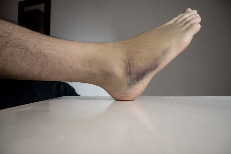 Qu’est-ce qu’une contusion ?