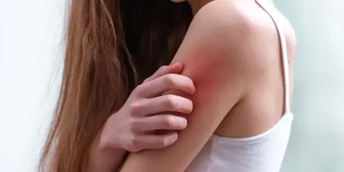 voornaamste symptomen van netelroos