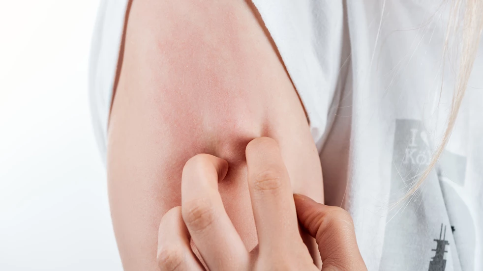 L'eczéma s'accompagne souvent de la nécessité de se gratter. Évitez de vous gratter pour que la réaction inflammatoire ne persiste plus.