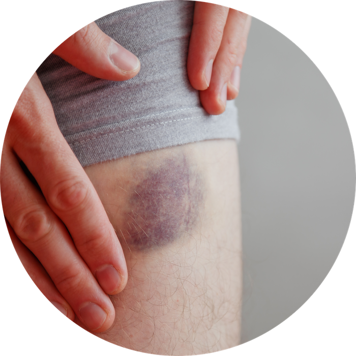 Un hématome à l’endroit