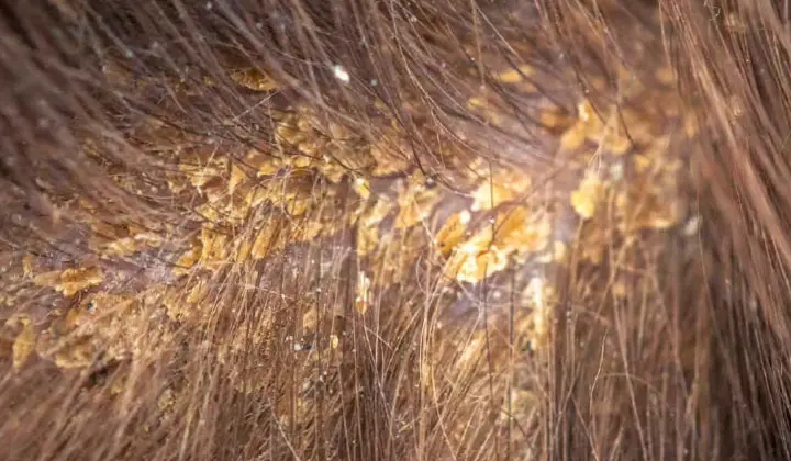 Er is sprake van seborroïsch eczeem wanneer de Malasseziacellen voor 83% aanwezig zijn. 