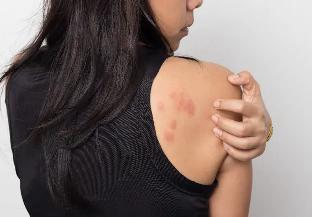 Herken de symptomen van netelroos