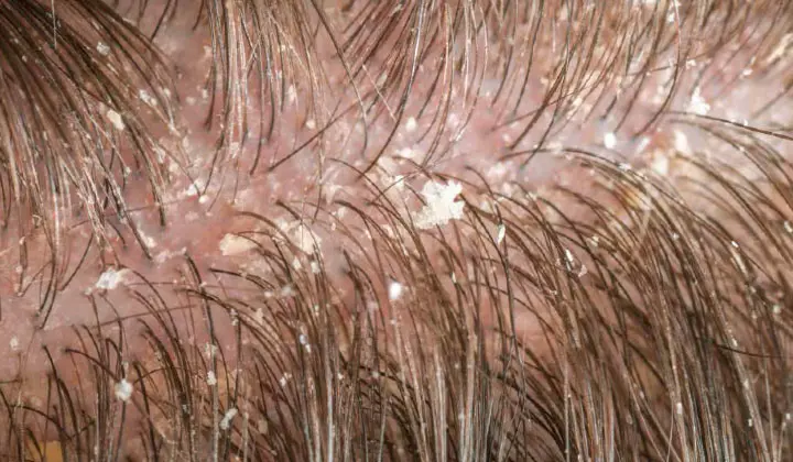 Wanneer er ongeveer 74% malasseziacellen op de hoofdhuid zitten, spreken we van roos. 