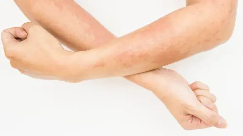 Le contact avec un certain allergène peut provoquer une réaction allergique de la peau.