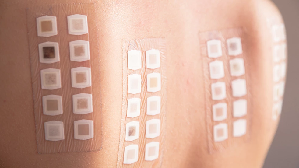 Un médecin peut découvrir pour quelle substance vous êtes allergique via des marqueurs collés sur la peau.