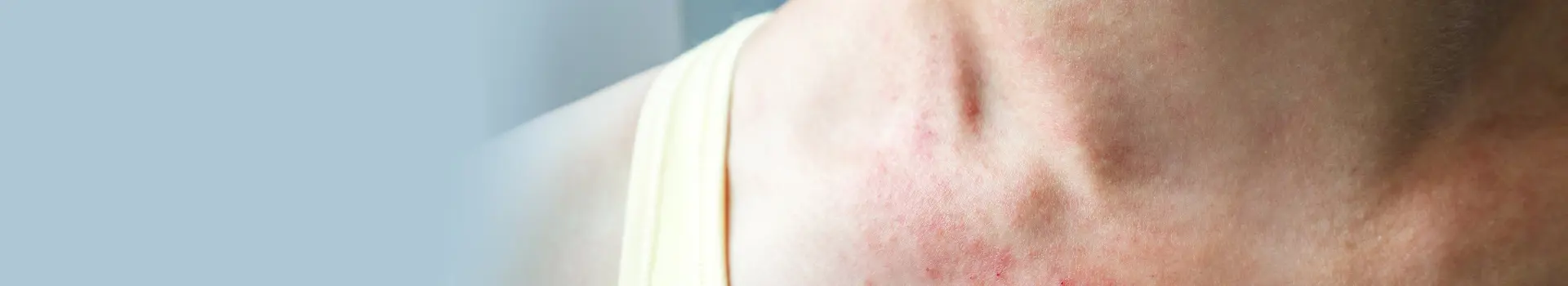 Qu'est-ce que l'urticaire et que pouvez-vous faire à ce sujet