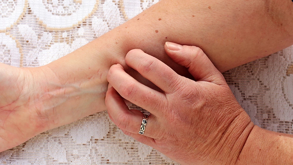 La neurodermite a souvent pour cause un facteur nerveux et s'accompagne d'un besoin important de se gratter.