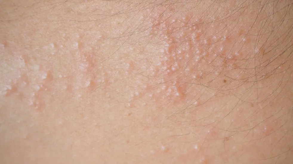 Certaines formes d'eczéma ont pour symptôme des vésicules qui démangent et qui peuvent se sécher en croûtes.