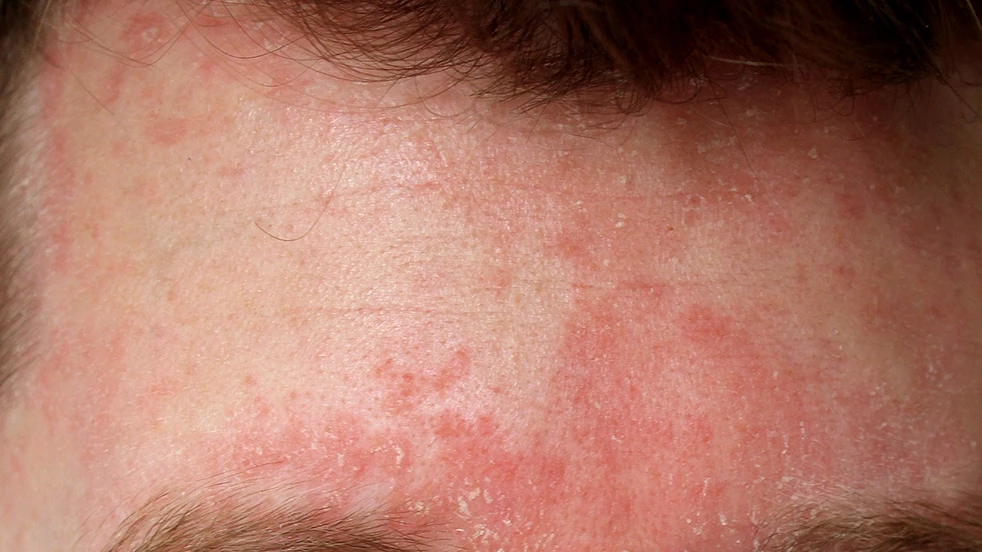 Seborroïsch eczeem ontstaat door de woekering van de schimmel Malassezia furfur. 