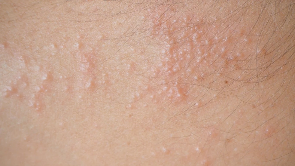 Certaines formes d'eczéma ont pour symptôme des vésicules qui démangent et qui peuvent se sécher en croûtes.