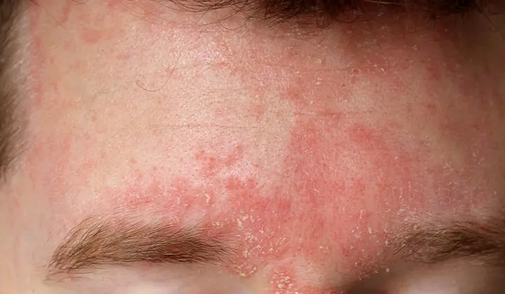 L'eczéma séborrhéique est une forme spécifique d'eczéma ou de dermatite.