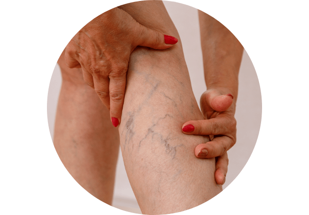 De aanwezigheid van zichtbare bloedvaten of spataders