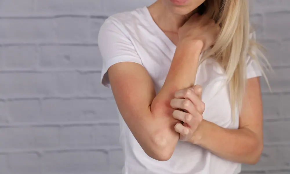 Pour tout savoir sur l'eczéma, cliquez ici.