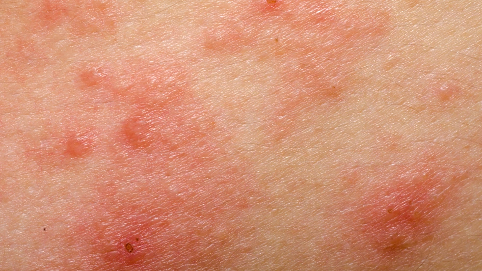 Des cloques rouges qui démangent sont également un symptôme typique de l'eczéma.
