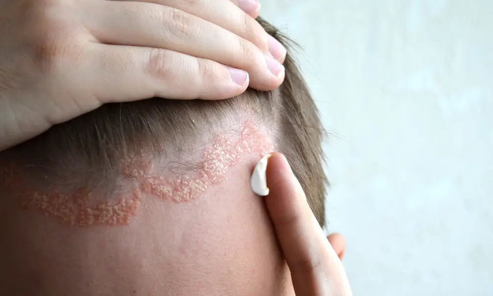 Seborroïsch eczeem op de hoofdhuid
