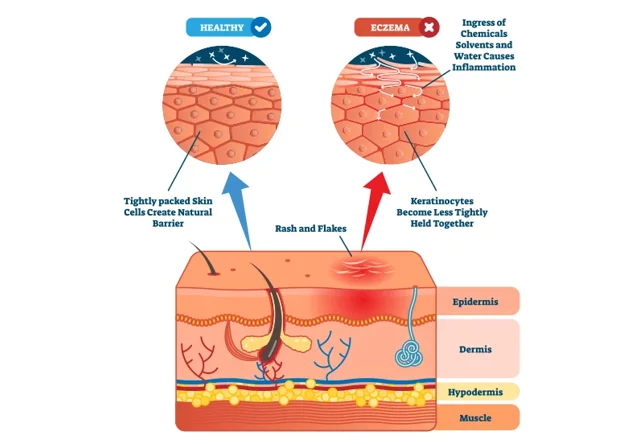 Eczeem is een chronische huidaandoening die uiteenlopende oorzaken kan hebben. 