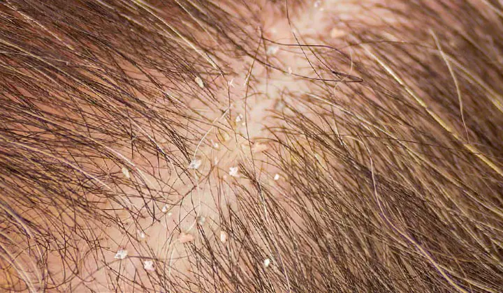 Ook op een normale hoofdhuid bevinden zich huidschilfers.